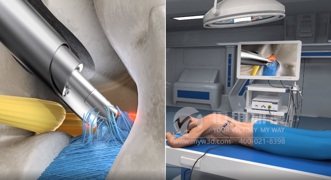 三維動畫設(shè)計助力醫(yī)學(xué)醫(yī)療行業(yè)健康發(fā)展！(圖4)